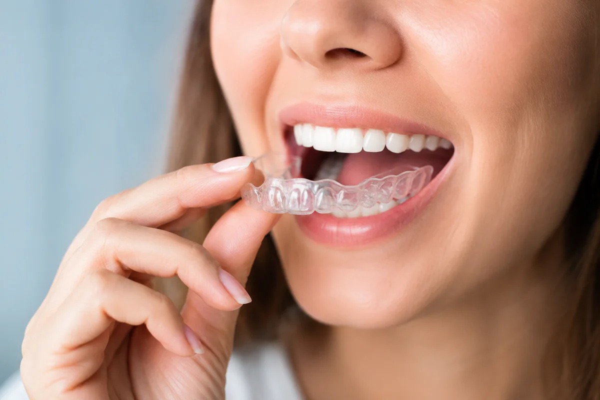 What Can You Expect Before, During, and After Your Invisalign Treatment